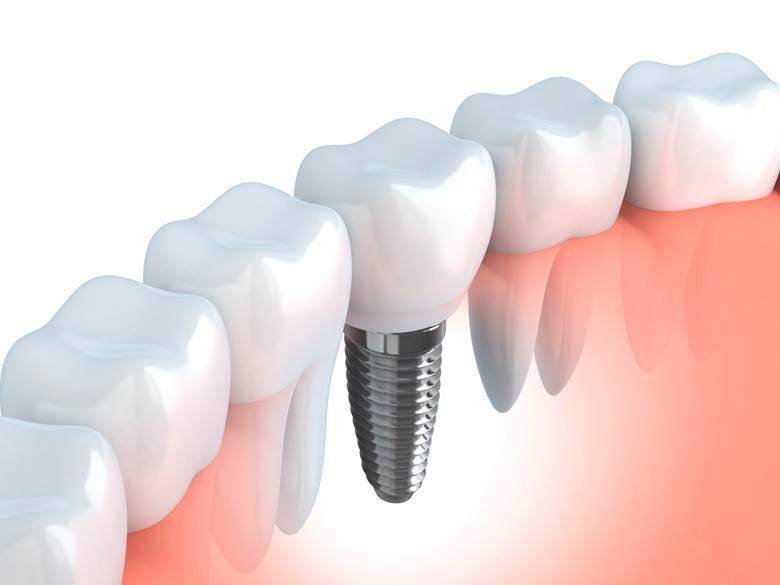 dental implant with a crown