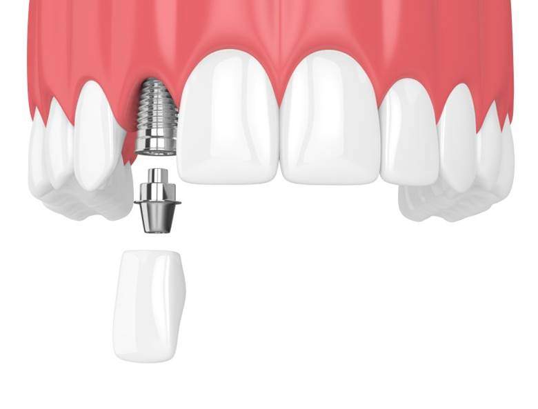 dental implant with a crown