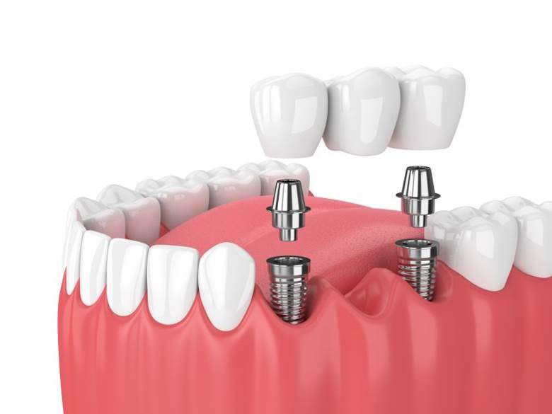 dental implant with a crown