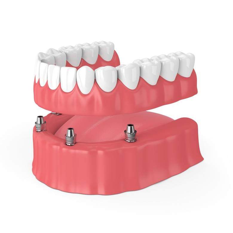 dental implant with a crown