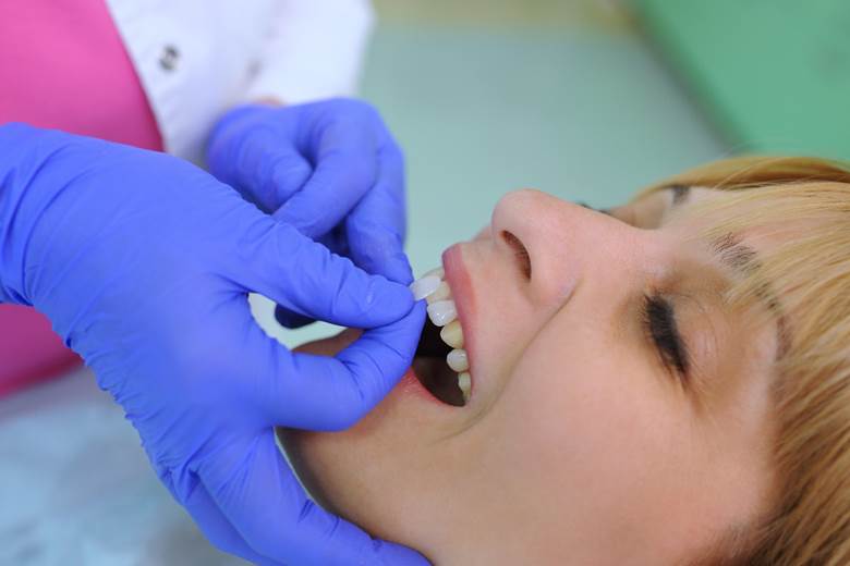 Cosmetic dentist in Toronto applying veneers to a patient
