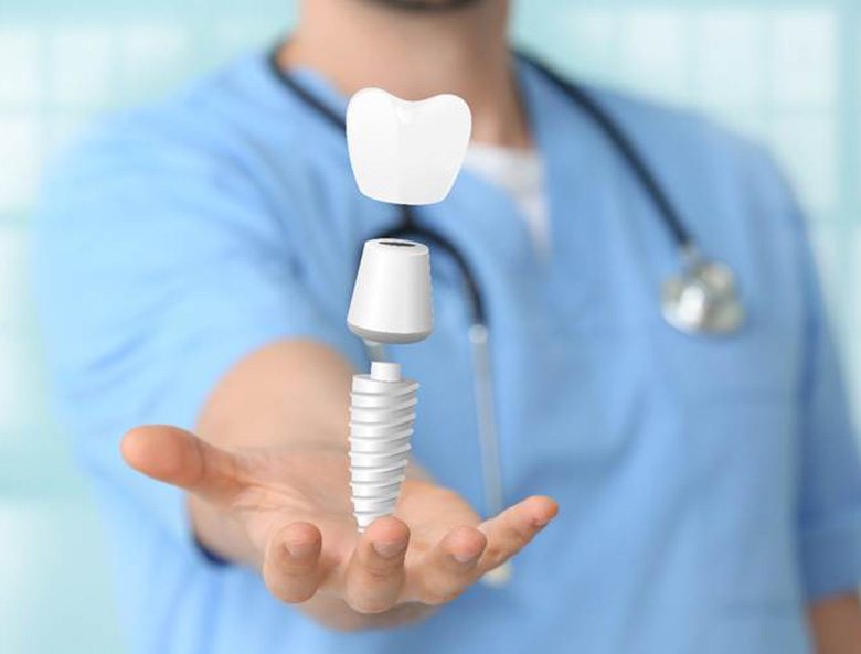 illustration for how dental implants work Toronto