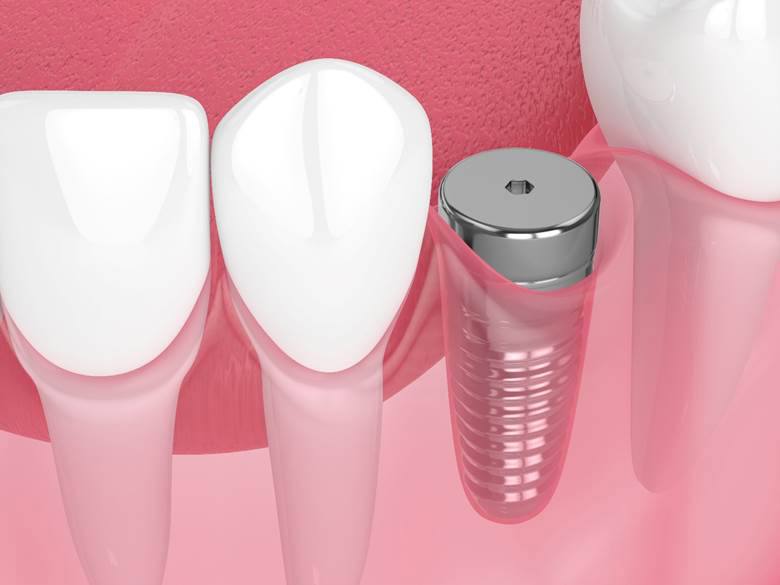 osseointegration illustration for how dental implants work Toronto